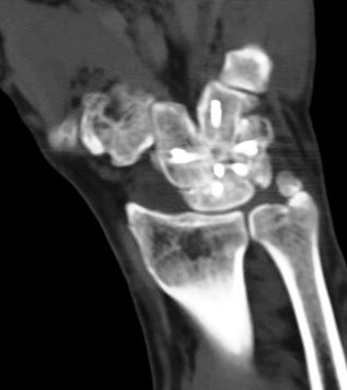 Figure 2 for case surgical carpal fusion ( RID2240 )